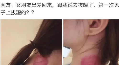 女朋友跟我说去拔火罐了,我该不该相信 哈哈哈第一次见在脖子上拔罐的