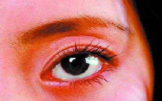 红眼病有什么症状图片