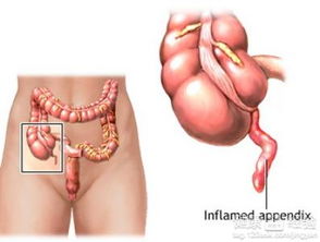 慢性阑尾炎的危害