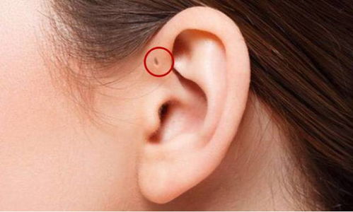 快看看你的耳朵前有这个小孔吗 它不是 聪明孔 是 危险洞 