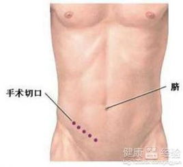 10岁的儿童患有阑尾炎，是怎么造成的要不要做手术