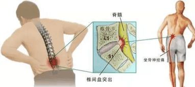 腰椎突出康复锻炼,最好的大夫是自己,4种锻炼方法用心坚持十天
