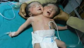 孟加拉再现双头婴 共用1个躯干2个头 系双头畸胎症 6成双头婴存活困难图