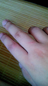 我被小猫的爪子抓伤了,需不需要打狂犬疫苗 