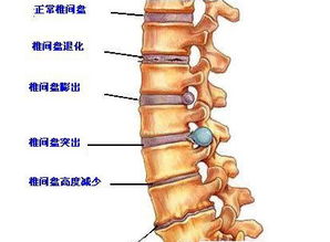 腰椎，颈椎问题压神经线导致右大腿麻木和肌肉萎缩