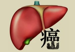 肝癌黄疸分几种,什么是肝癌的肝细胞性黄疸