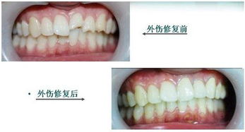 牙齿缺损的修复方法有什么