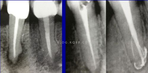根管治疗成功的保障