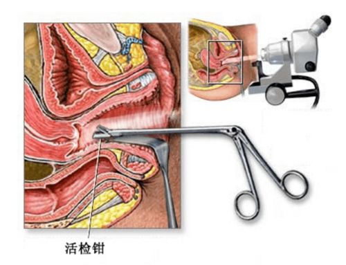 阴道镜检查是什么 活检又是怎么一回事呢