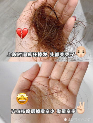 中医养生女性秃头,秃顶要怎么治疗？