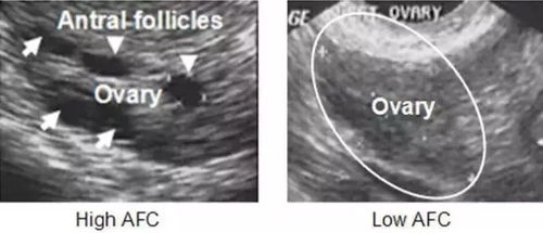高龄生育窦卵泡计数 AFC 是什么检查 窦卵泡数与生育能力的关系都在这里