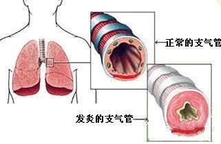 支气管炎艾灸治疗方法