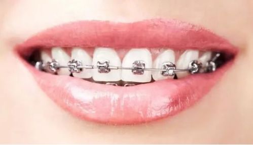 牙齿矫正误区有哪些呢
