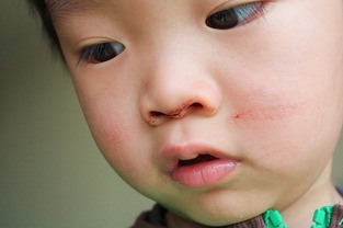 鼻子出血是什么原因 成人 男生,鼻子流血，提示得什么“大病”了？