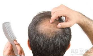 脱发的原因，脱发的治疗方法有哪些(脱发的原因及治疗方法)