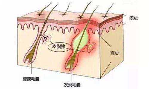 凸起的毛囊能烫平吗