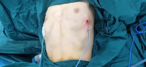 超微创术 西安市红会医院胸部外科成功以超微创术式完成两例复杂胸廓畸形