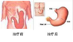 胃下垂的原因是什么？