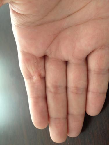手被玻璃割伤伤到十指肌腱,手术缝合后,手指却伸不直了 这样的情况还能有方法治愈吗 