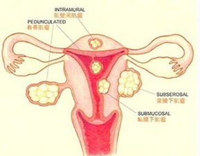 功能性子宫出血的症状有几种