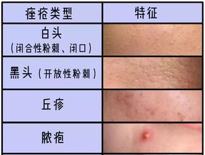 9块9消灭闭口 这个方法不告诉你,我良心会痛