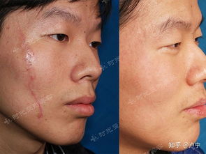 请问易疤体质的女孩子小时候在脸上留下的缝合疤痕现在能通过整形得到恢复么 