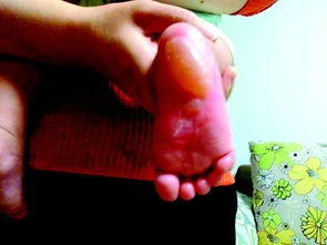 六月大婴儿做艾灸脚底被三度烫伤 