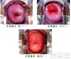 中度宫颈糜烂能做人流吗