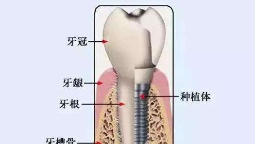 为什么有些人做种植牙,得先植骨 植入的到底是什么 