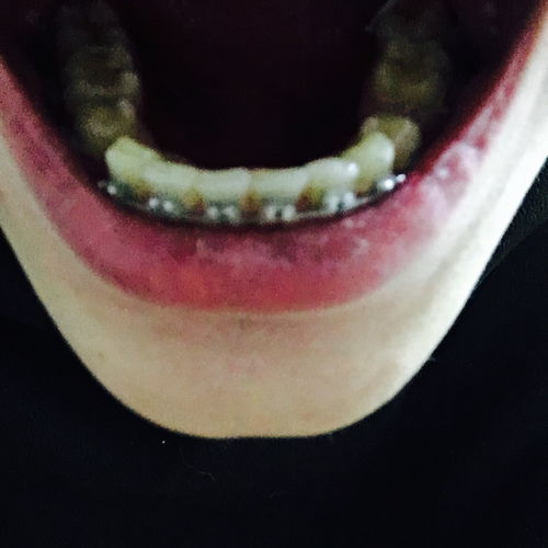 23岁整牙合适不合适(23岁可以整牙齿吗)