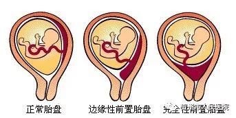 我院多学科成功抢救一名凶险性前置胎盘产前大出血产妇