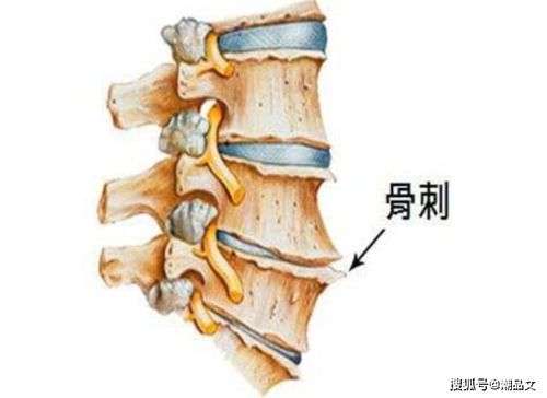 科普 不是普通颈椎痛,久坐久站的上班族可能长骨刺了