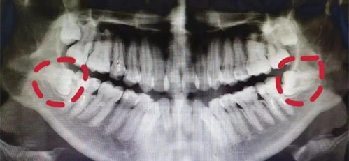 拔智齿还有最佳时间 千万不要错过