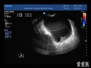 膀胱壁上的东东 望各位老师多给指点质点