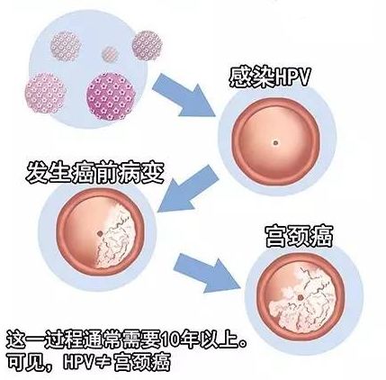 hpv是什么意思，HPV感染是什么意思