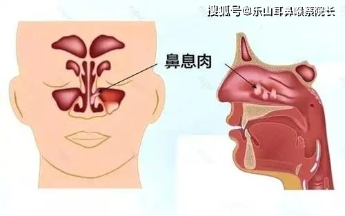 经常鼻塞流鼻涕,警惕 鼻息肉