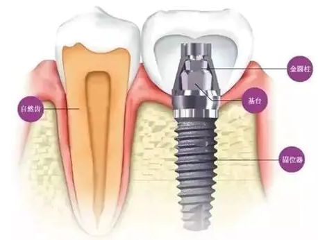 种植牙是永久的吗 种植牙能保持多久