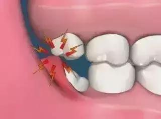 智齿拔掉对老了以后的牙齿有影响吗