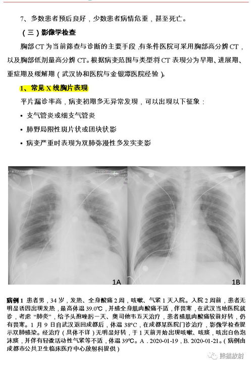 新型冠状病毒肺炎 如何检查及诊断更优化