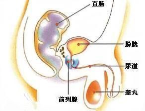 前列腺炎反复发作的原因是什么 