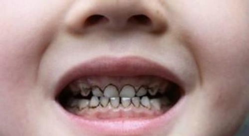 宝宝门牙龋齿初期图片