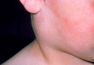舌下腮腺炎有什么症状,腮腺炎临床表现有哪些?