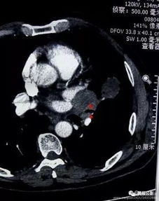 小细胞肺癌病理切片图 搜狗图片搜索