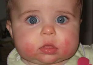 婴儿口周围湿疹,宝宝嘴周围总是有湿疹怎么办？