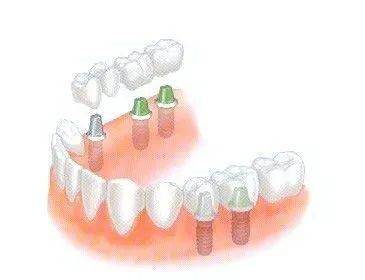 种植牙分为几种 老年人适合做种植牙吗