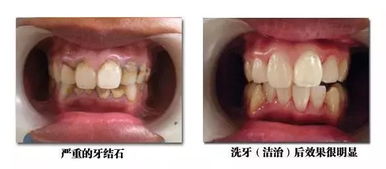 医生,洗牙后我牙齿酸软咋回事 