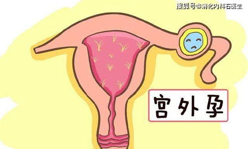 女子流产后腹痛,针灸治疗5天,医生一看 子宫穿孔了