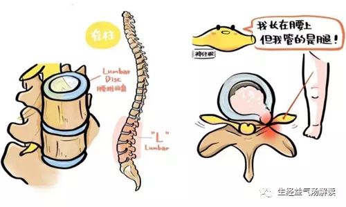 马尾神经受损伤的早期