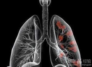 肺癌科学的医治是什么