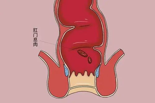 肛门褶皱处多出一块肉是怎么回事(肛门褶皱处长了个肉揪很疼怎么办)